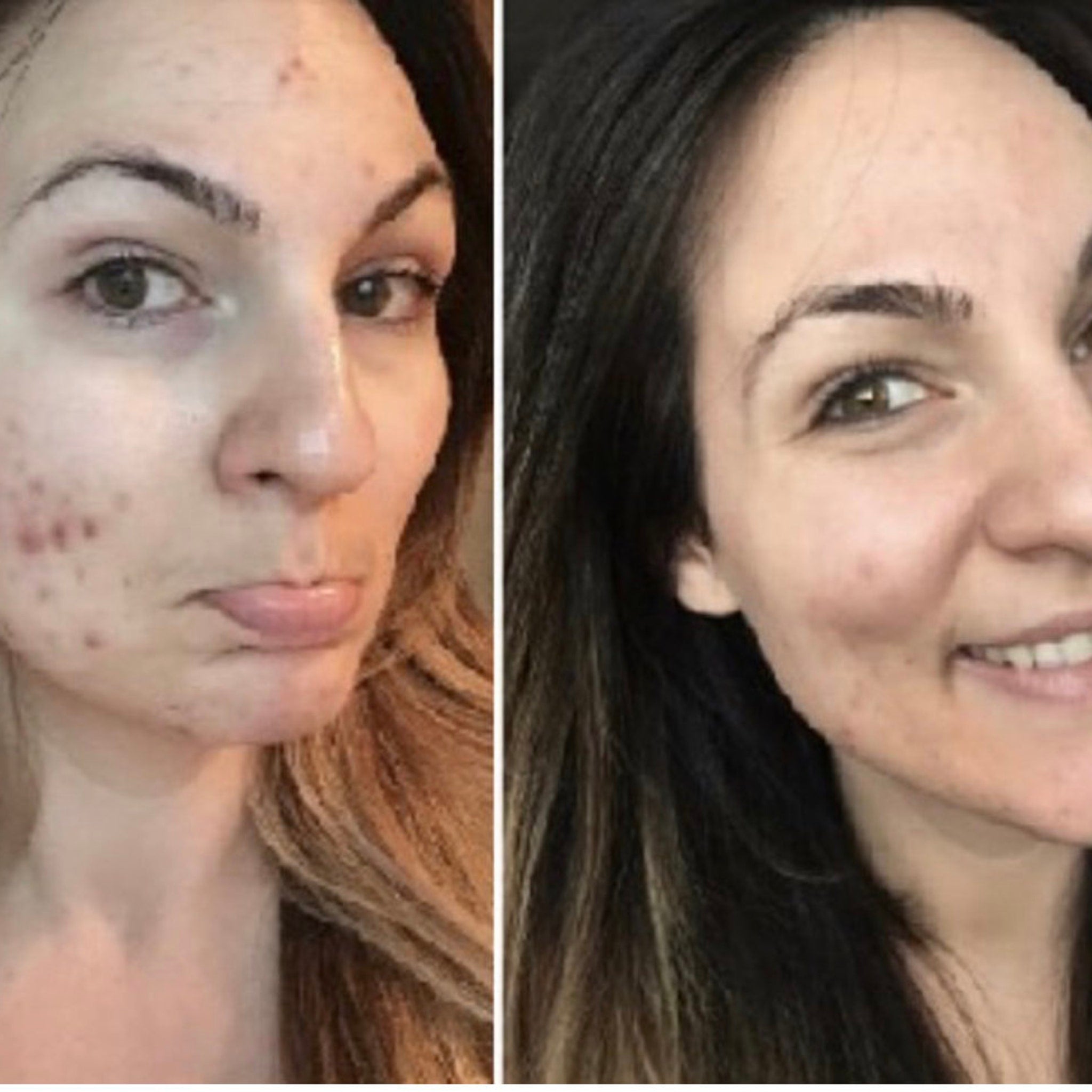 White plastic squeeze tube of 10% benzoyl peroxide acne wash with blue text on matte finish