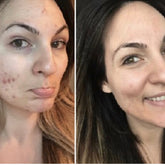 White plastic squeeze tube of 10% benzoyl peroxide acne wash with blue text on matte finish