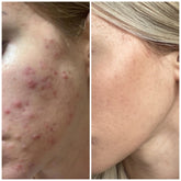 Pimple cream comparison, skin with red blemishes, smooth skin on right side, before and after use