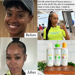 Skincare before and after photos, showing woman with clear skin, next to bottles of B.E. HERB'D products on wooden board