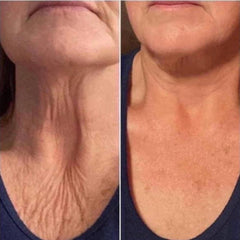 Neck comparison showing wrinkled skin and smoother skin, before and after, with blue top