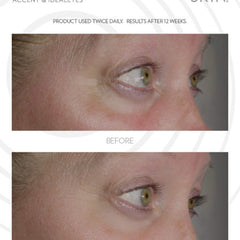 Eye skin before and after comparison, showing light skin tone, wrinkles, and green eyes