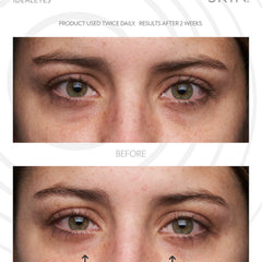 Eye comparison showing before and after results, with green eyes and fair skin, arrows pointing to under eye area