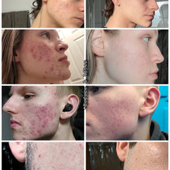 Acne treatment before and after comparison showing red skin with blemishes and smoother skin