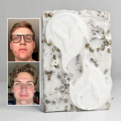 Acne Face Wash, white soap bar with a swirl design and brown flecks, with before and after images of faces