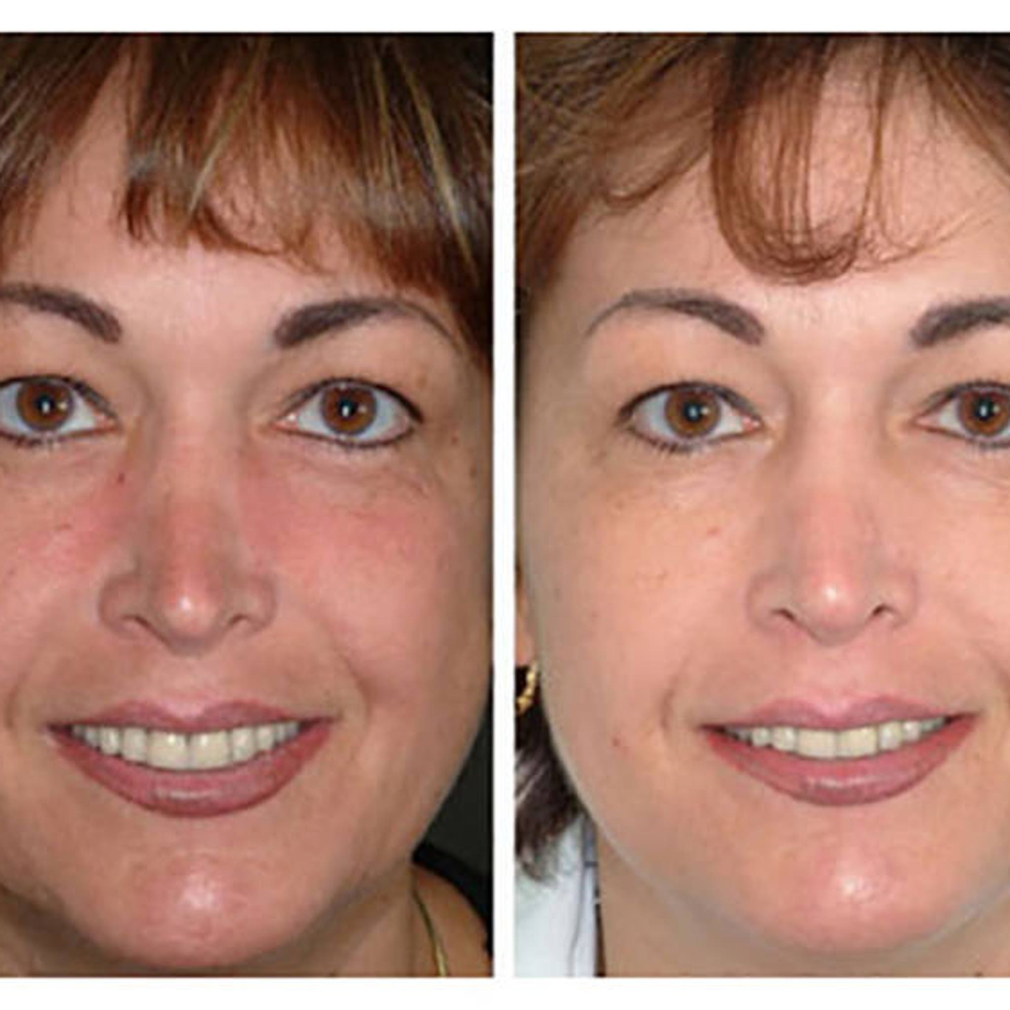 Before and after face comparison, showing skin tone, eyes, and smile, side by side images