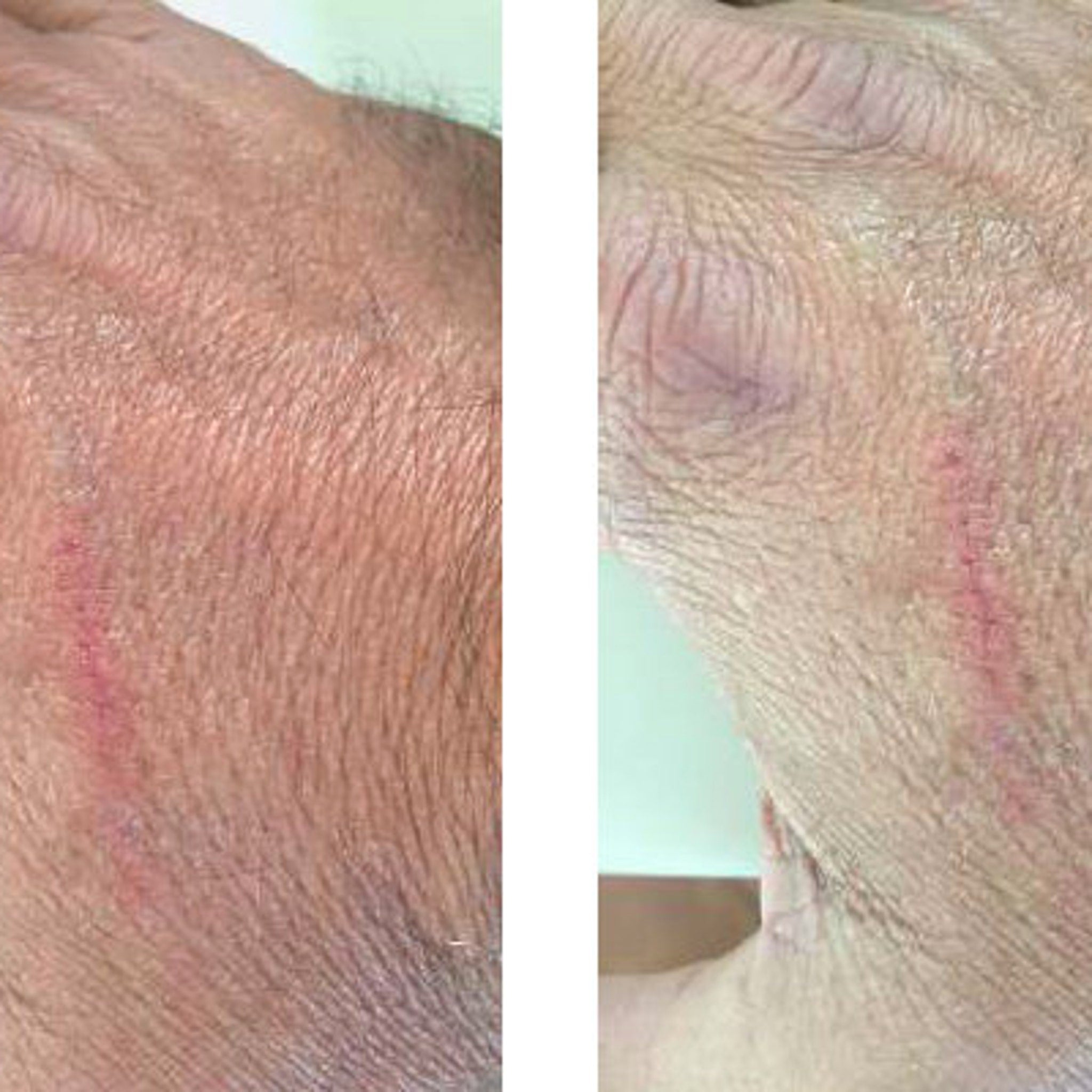 Human skin with reddish-pink scar, light brown tone, and visible texture