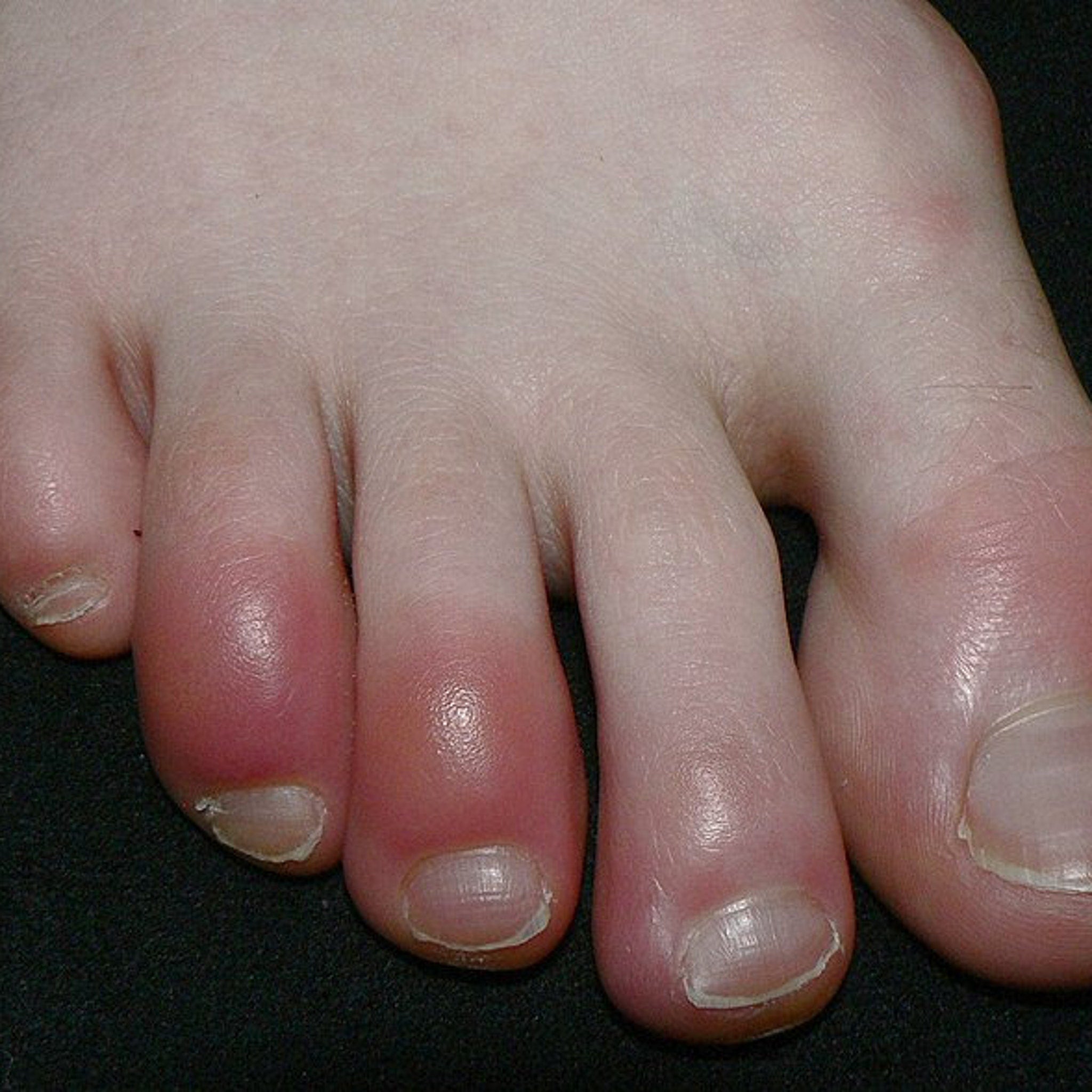 Toe with red and pink skin, visible nails, and black background