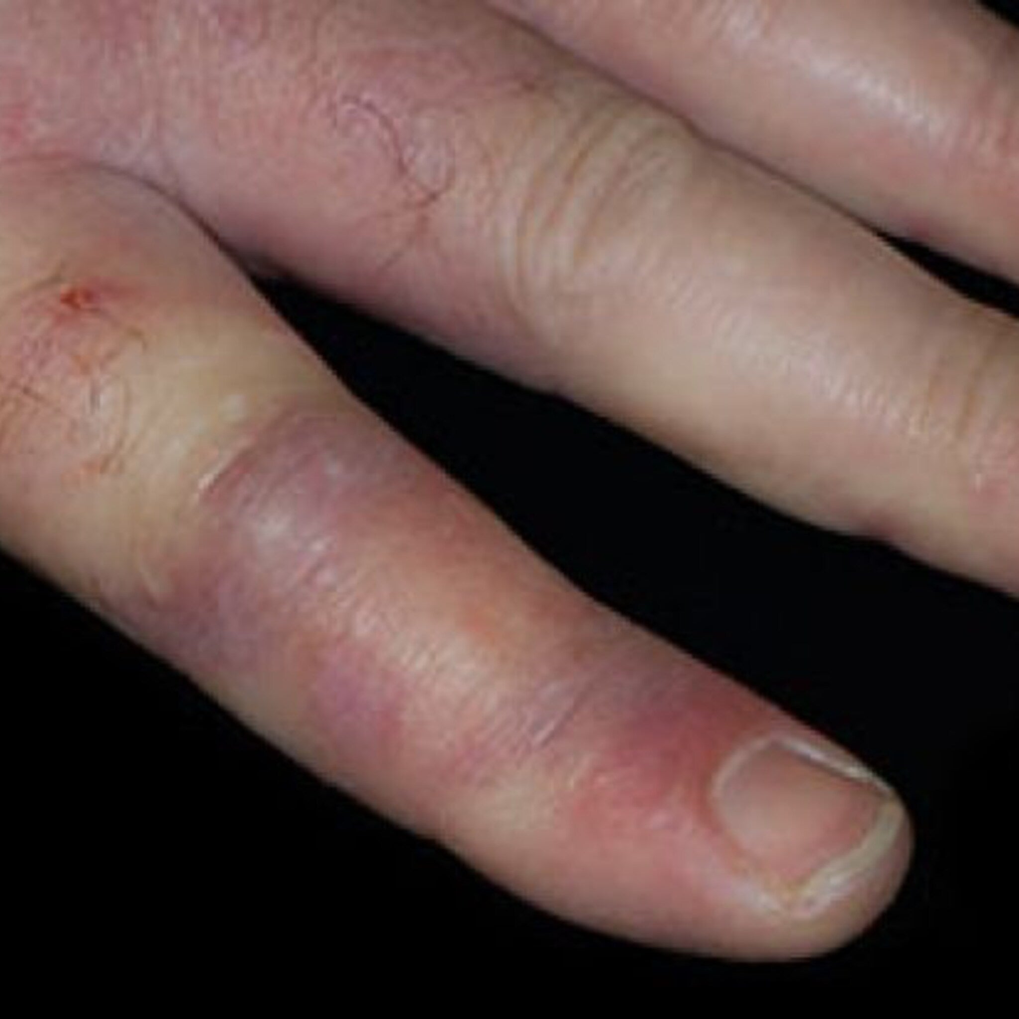 Finger with purple and red discoloration, swollen appearance, and pale nail