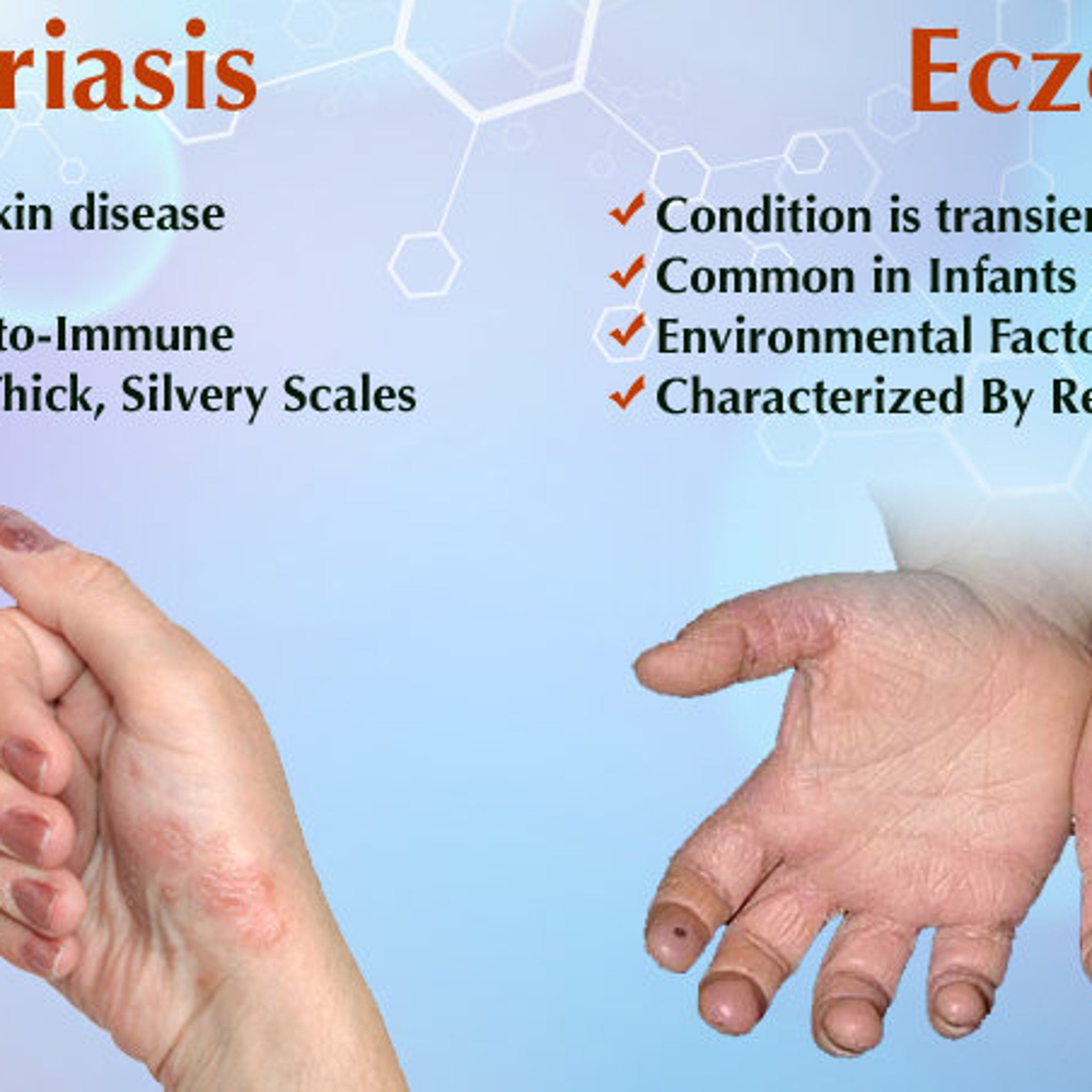Skin condition image showing red, textured skin on hands, with text about the condition