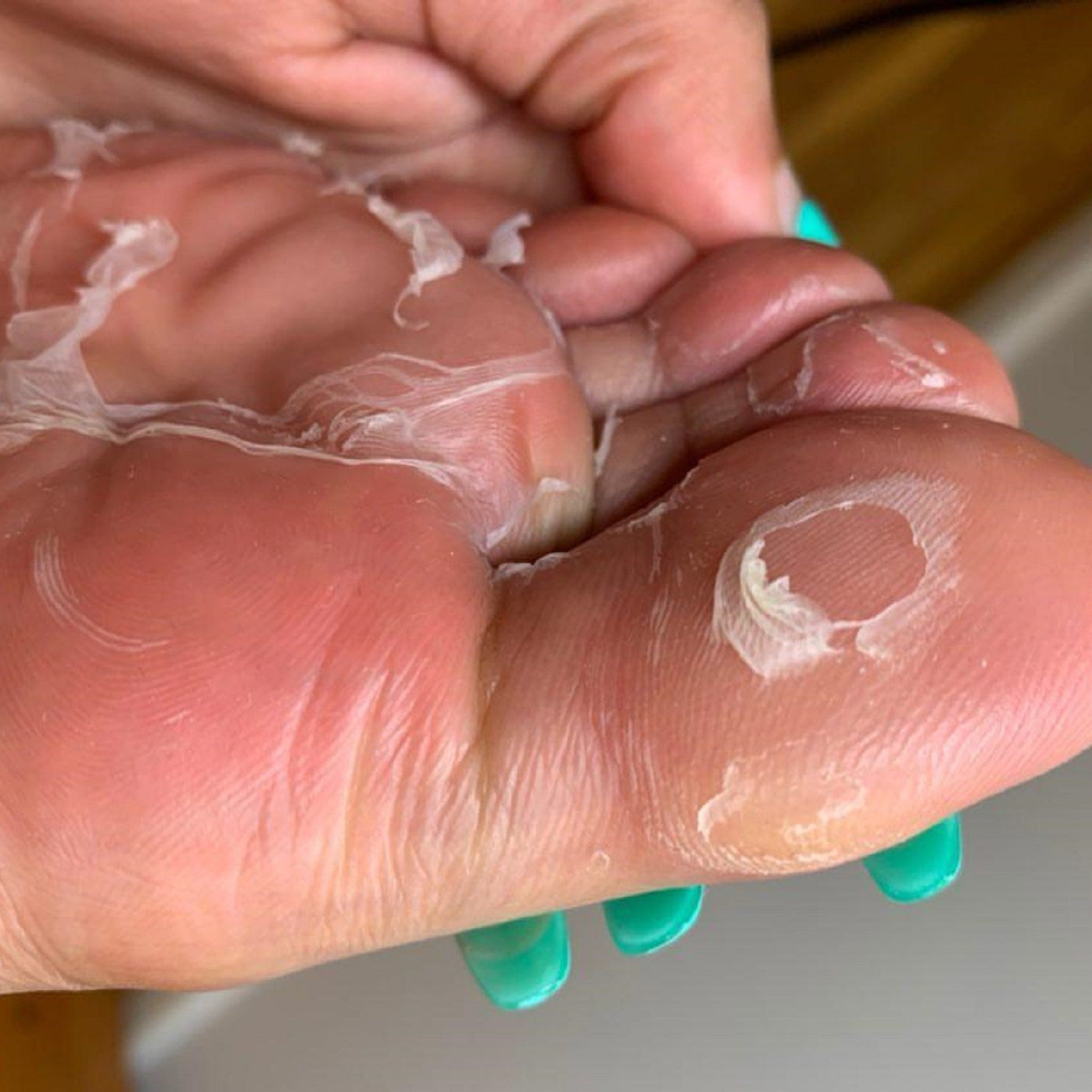 Foot peel skin peeling with white and translucent flakes on pink skin and green nails