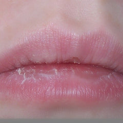 Dry cracked lips with pink skin, flaky texture, and close-up view