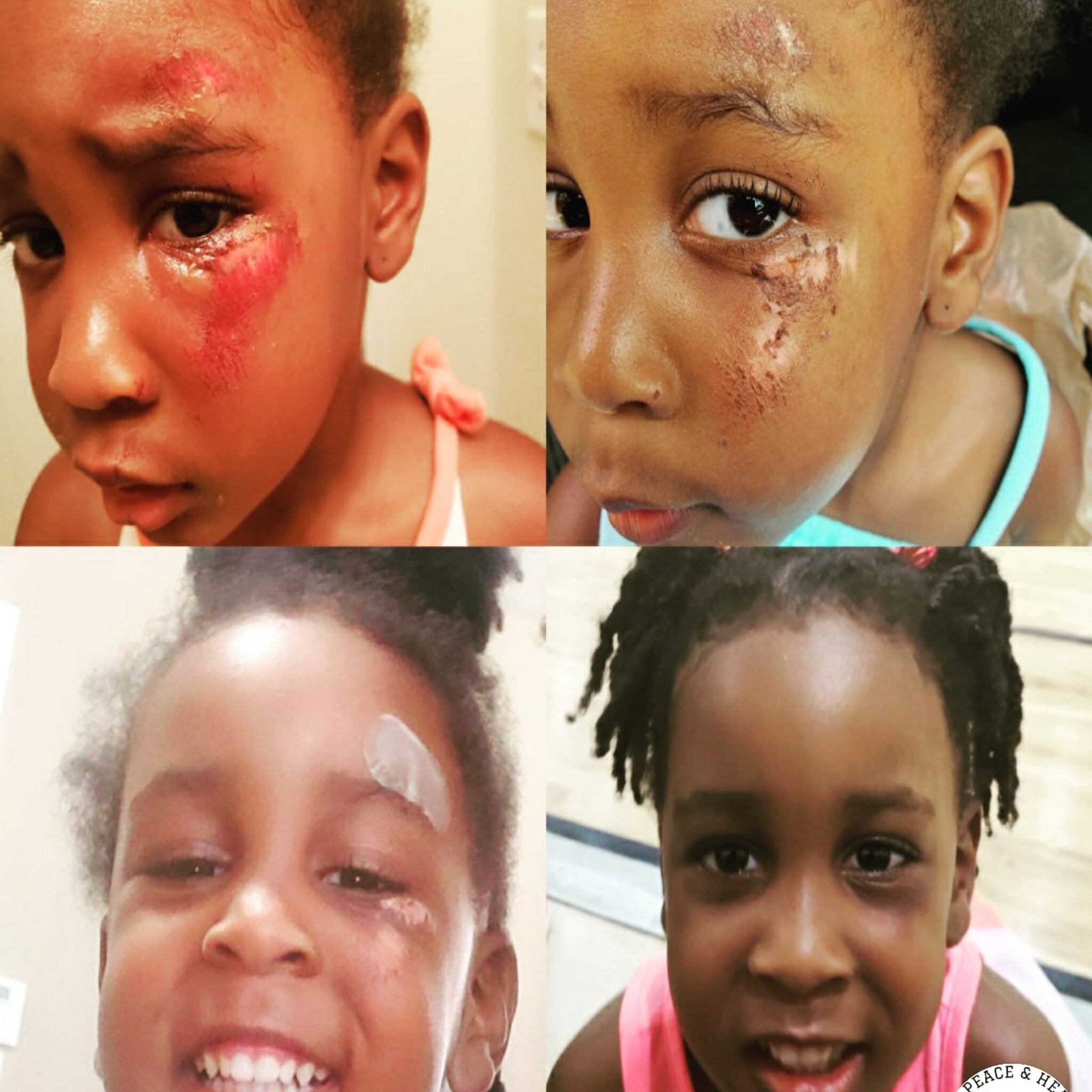 Child's face with red and brown skin injuries, showing a tear, and a bandage on forehead.