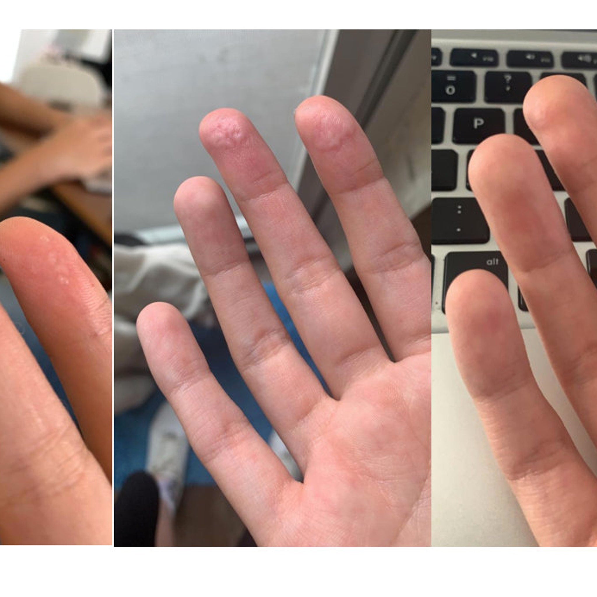Skin with small bumps, pink skin, fingers with a laptop keyboard in the background