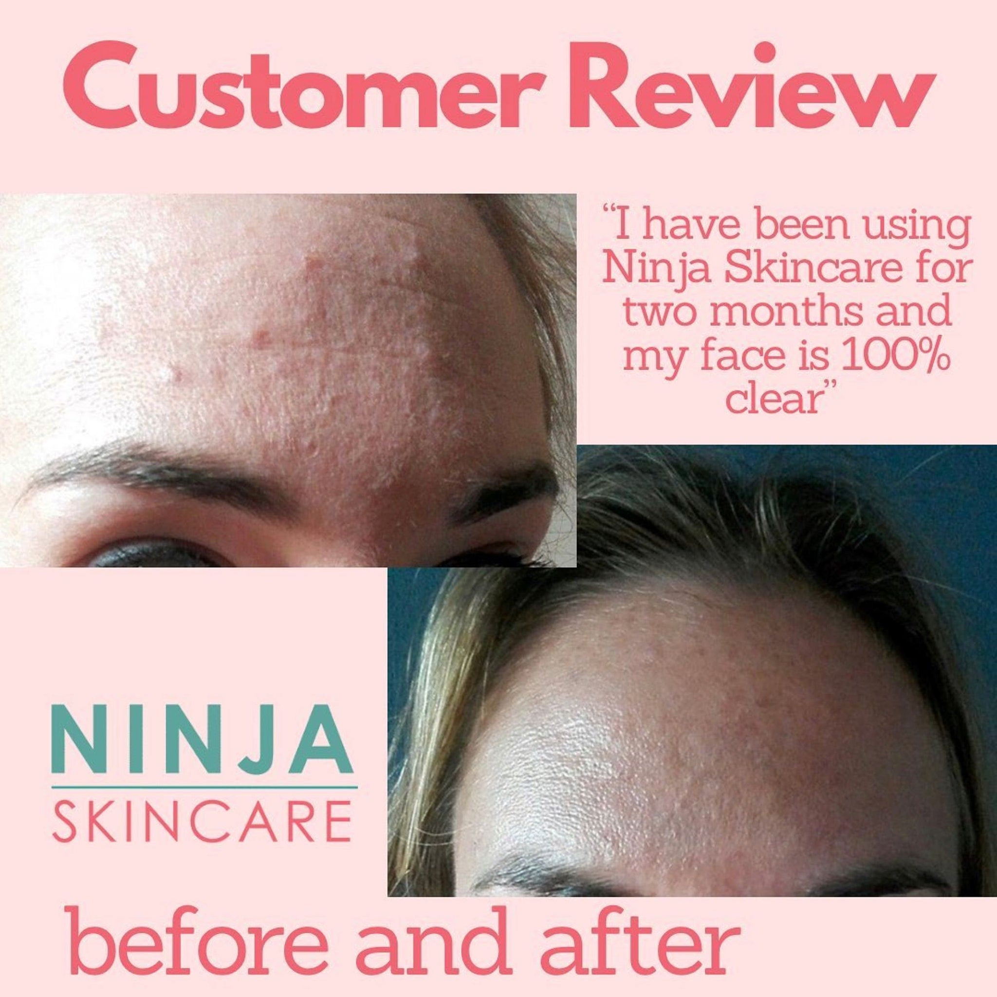 Additional view of 10 Benzoyl Peroxide Acne Wash for Oily Acne-Prone Face  Body