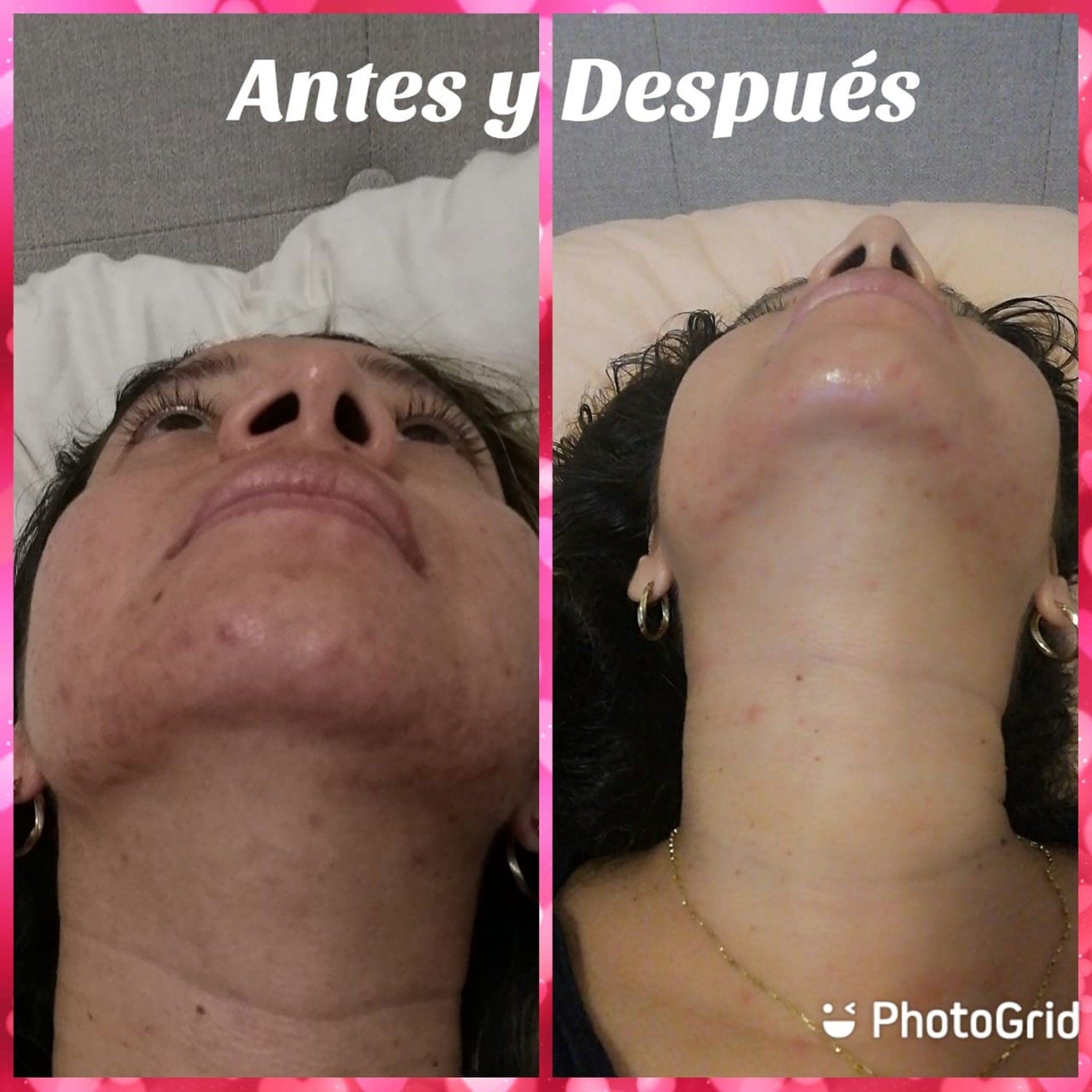 Facial skin comparison, showing before and after, with visible skin texture, and gold jewelry.
