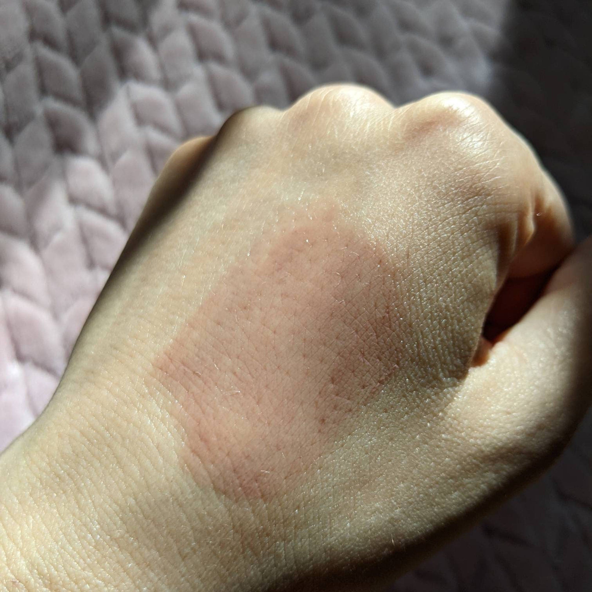 Skin with red patch, showing texture and light, possibly showing a reaction