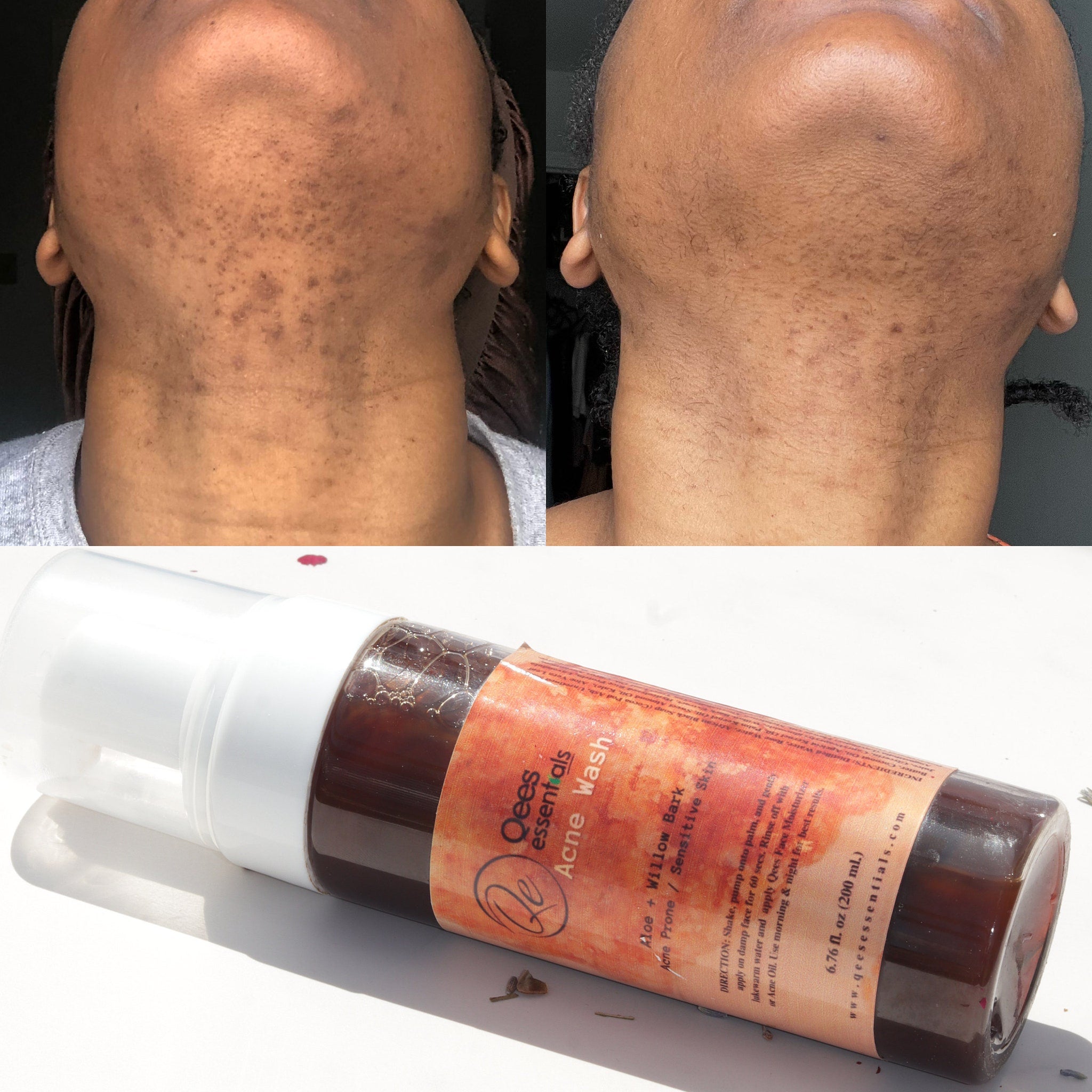 Additional view of African Black Soap Acne Face Wash for Sensitive  Oily Skin - Natural Cleanser