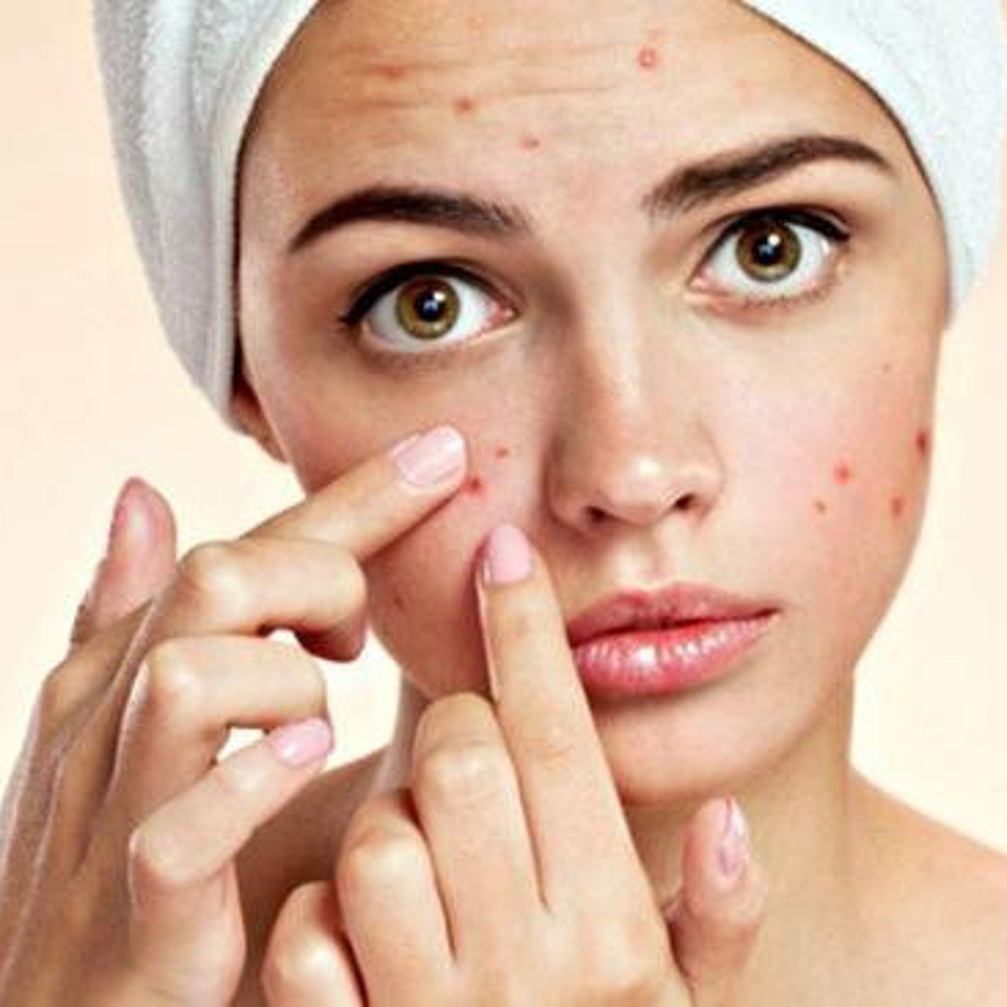 Acne on face with red spots, white towel, and fingers touching skin