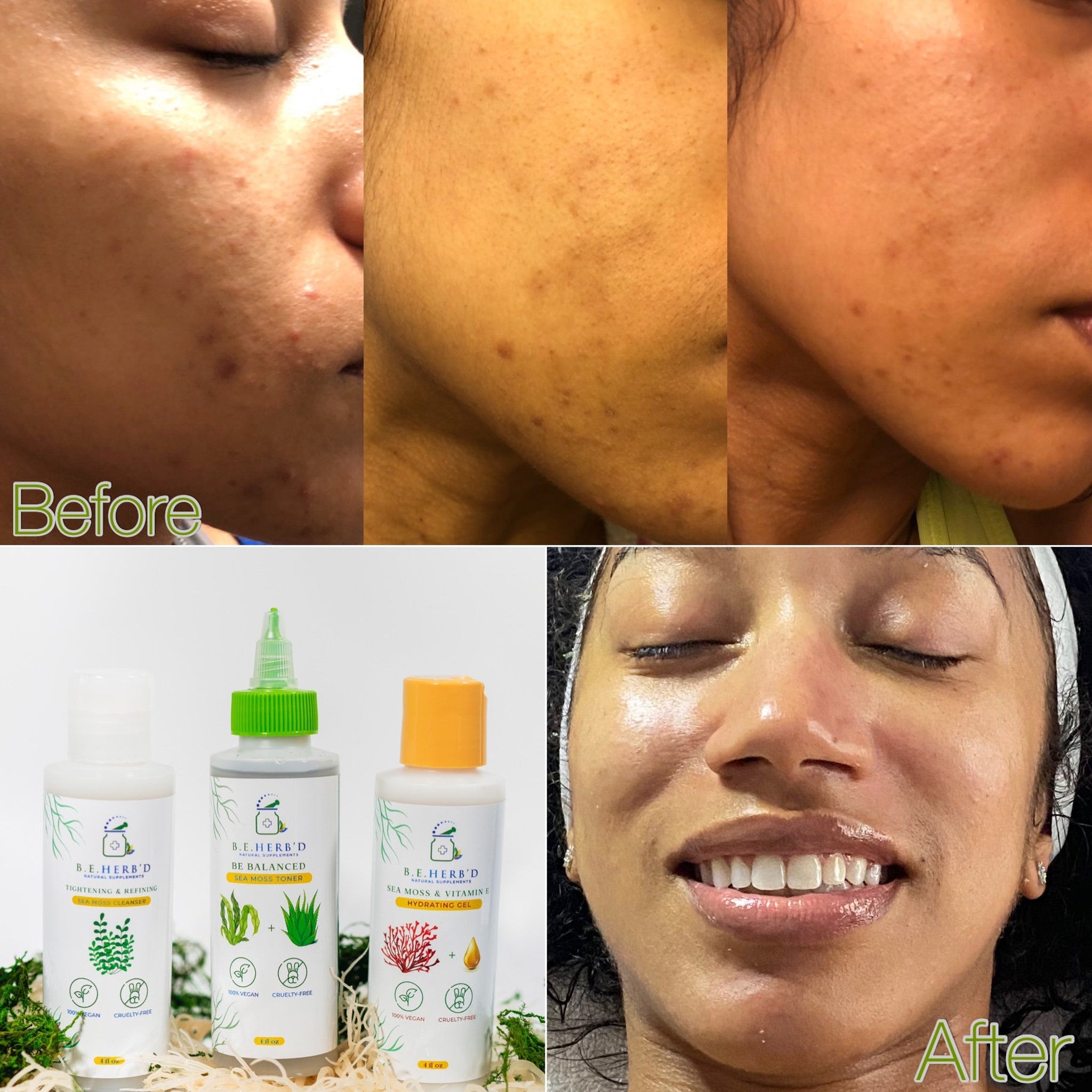 Skin comparison showing before and after, with visible skin texture and B.E. HERB'D products in the image.