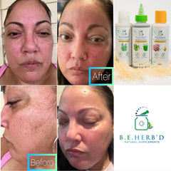 Skin care product comparison with before and after images, featuring facial skin with redness and B.E. HERB'D products.