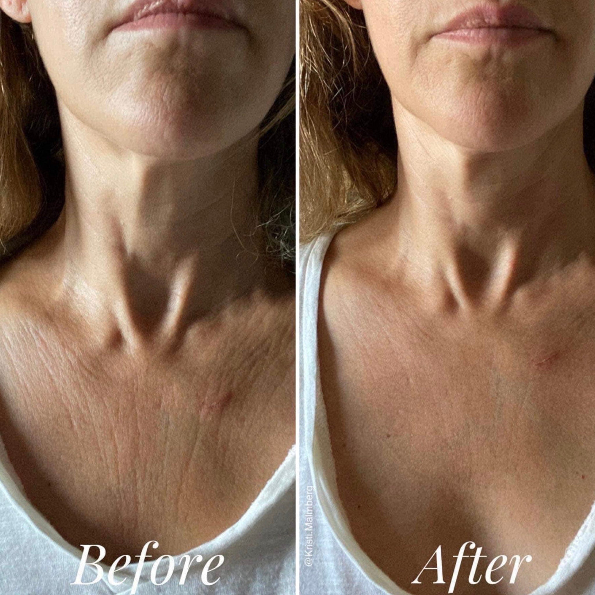 Skin comparison showing before and after, showing skin texture, light skin tone, and white top.