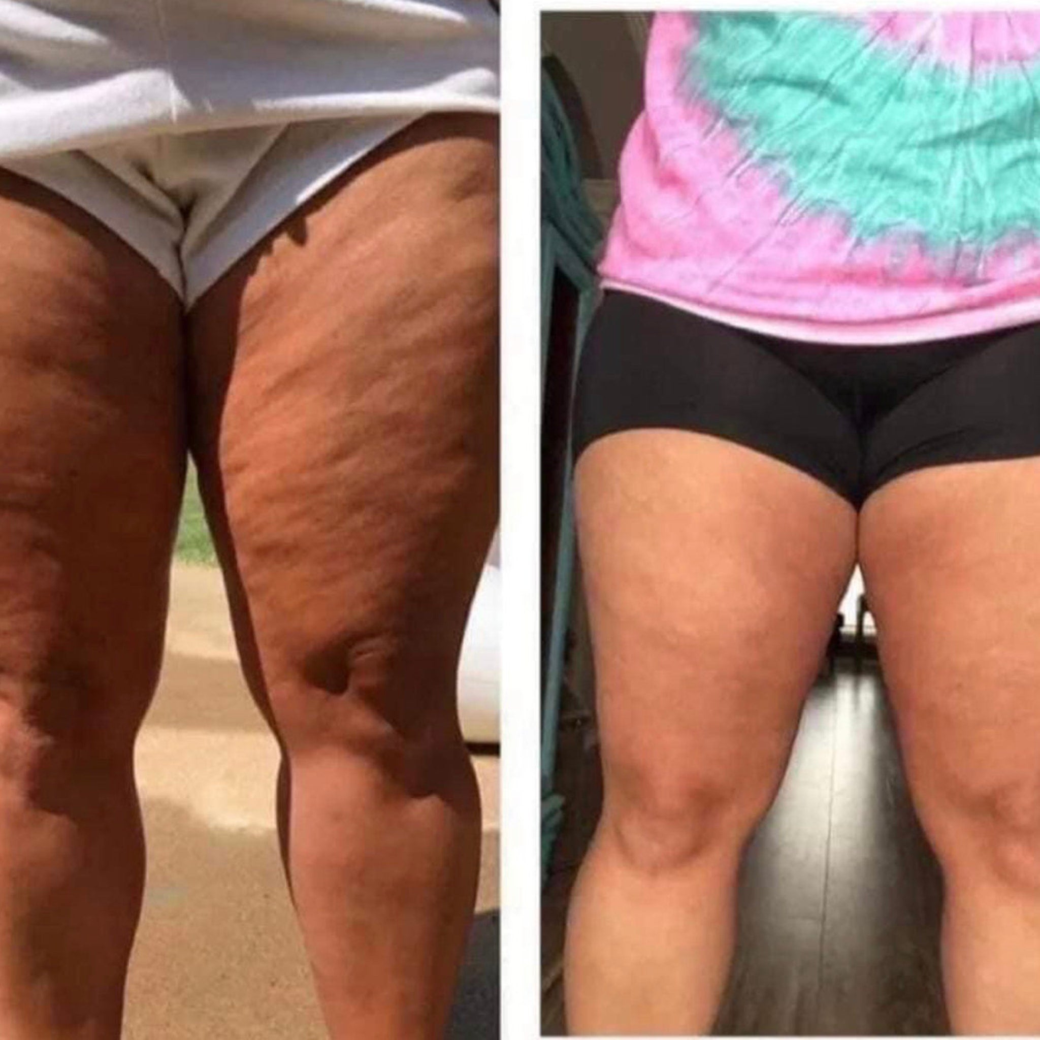 Thighs with skin texture, wearing white and black shorts, standing in front of a background