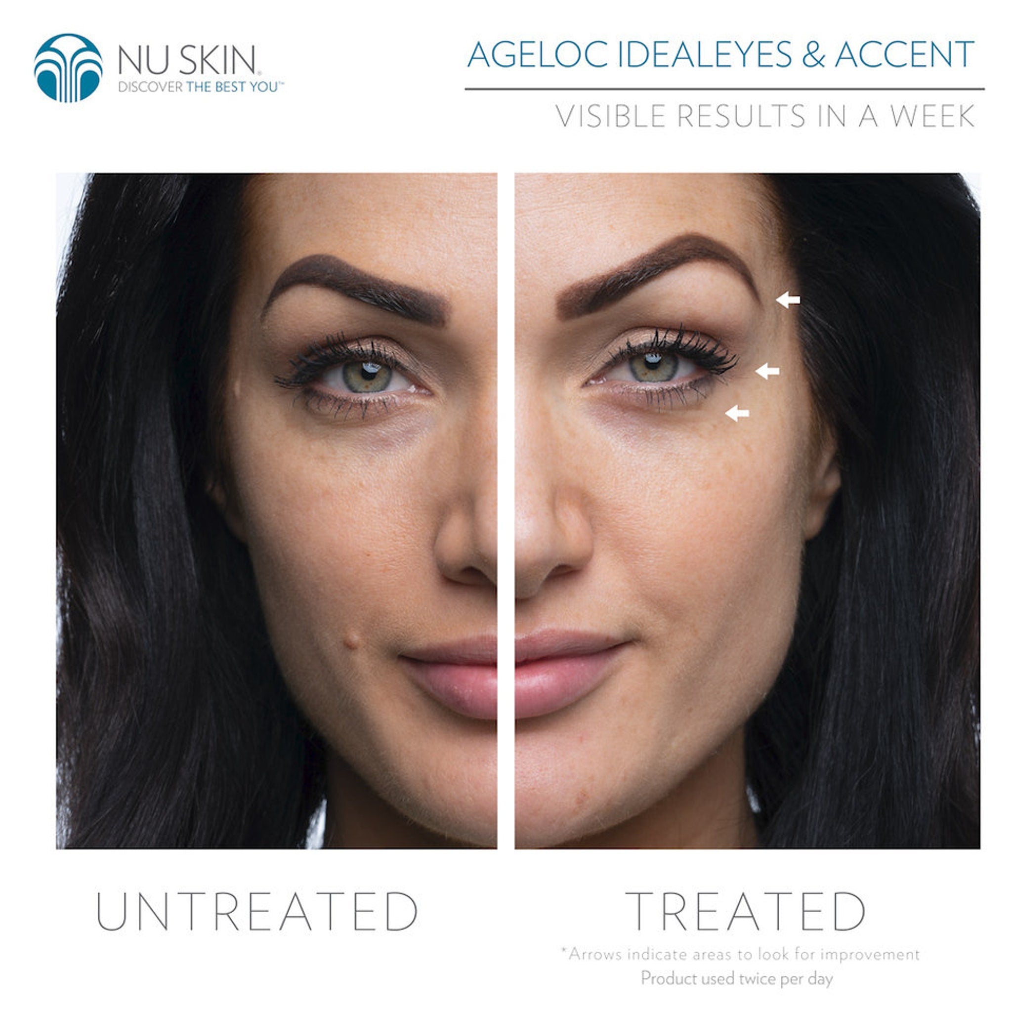 Before and after facial comparison with dark hair, fair skin, and white arrows indicating areas of improvement