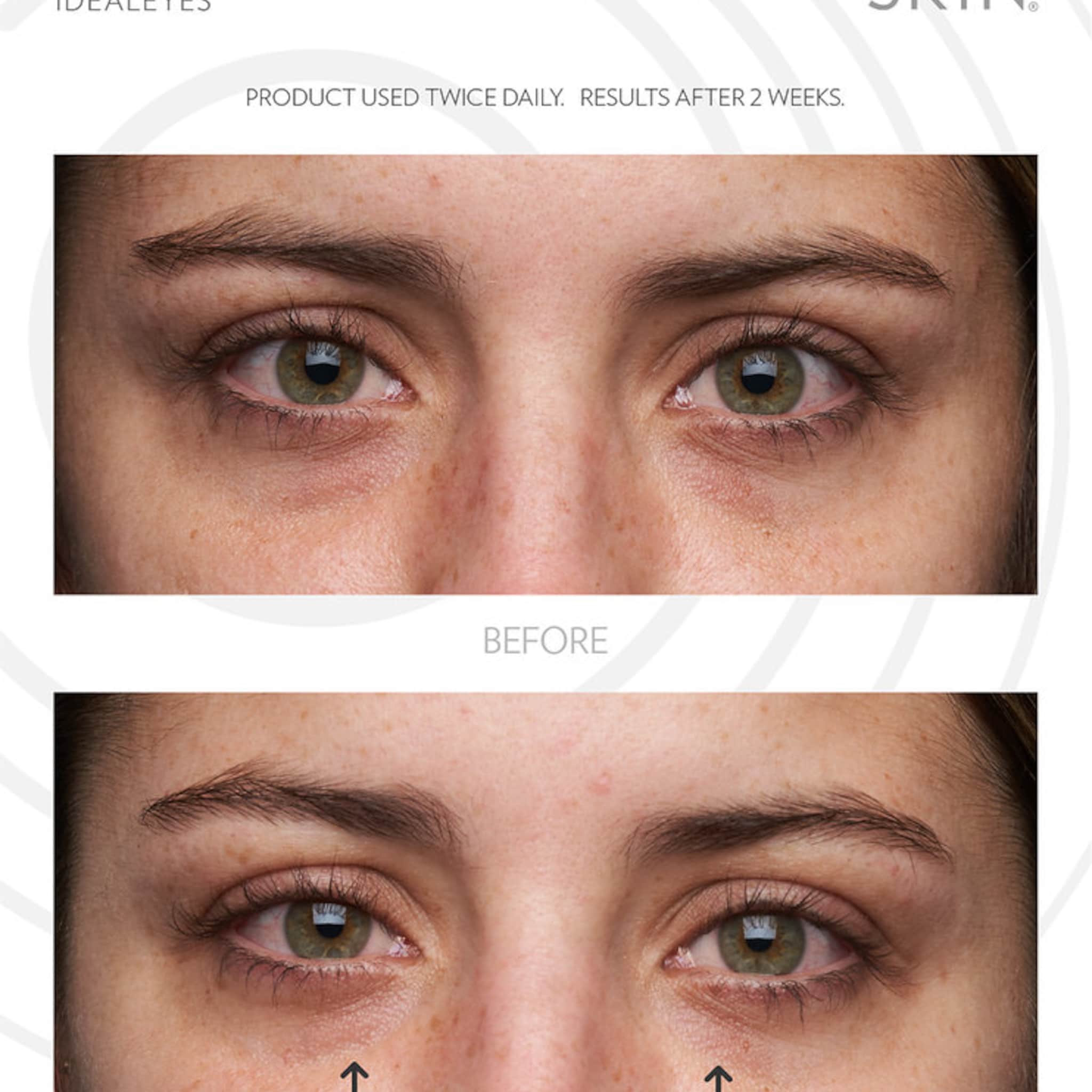 Eye comparison showing before and after results, with green eyes and fair skin, arrows pointing to under eye area
