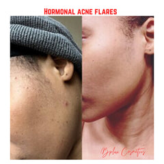 Acne comparison, skin tones with acne and clear skin, Bplux Cosmetics logo in red script