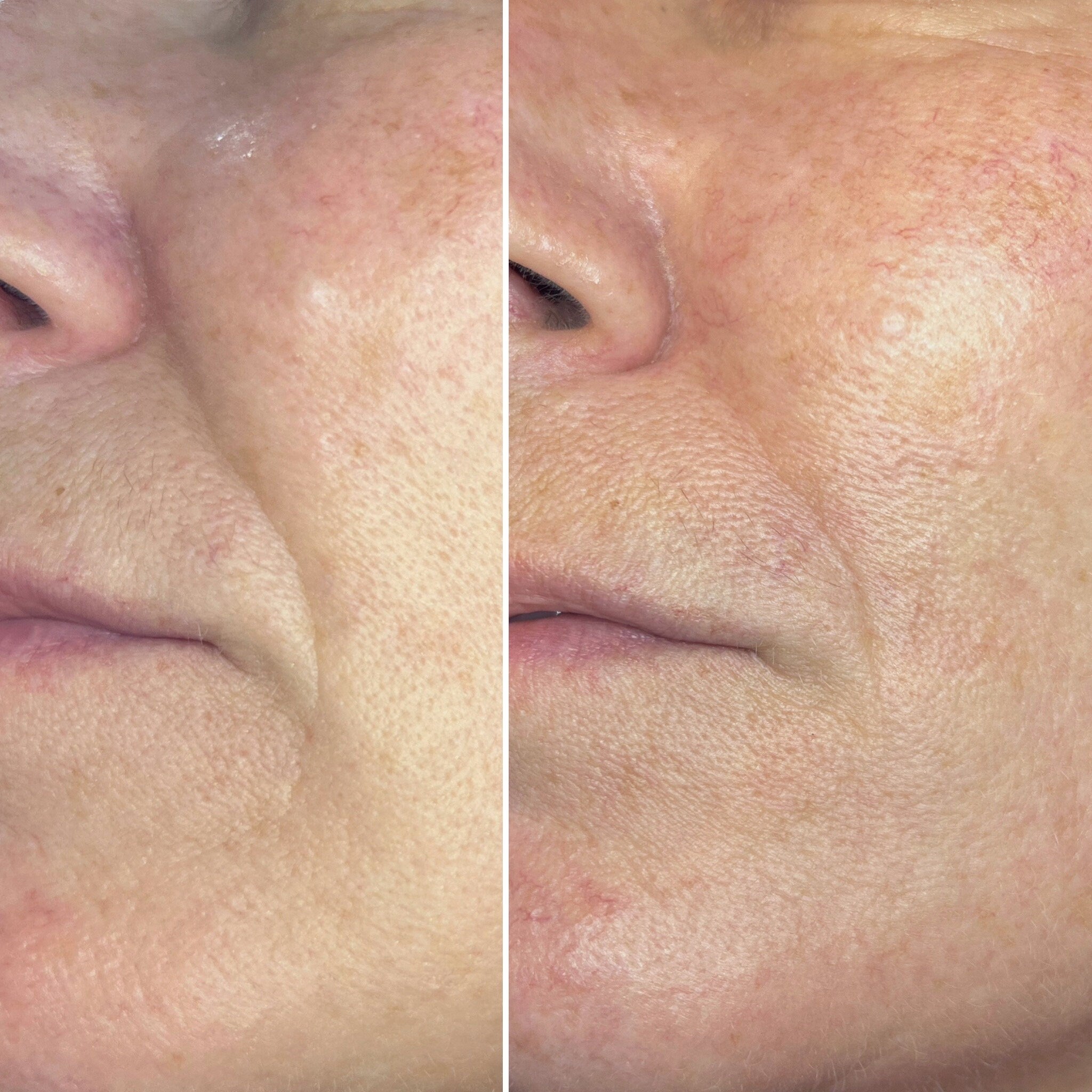 Skin texture comparison showing before and after, with visible redness and wrinkles, light skin tone