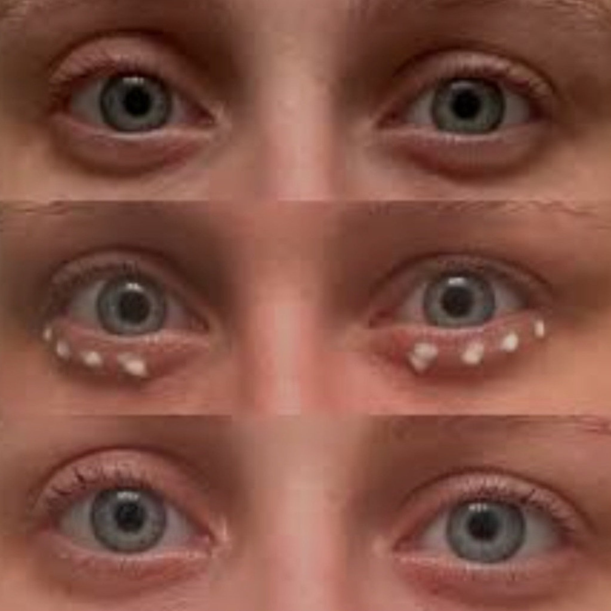 Eyes with gray irises, fair skin, and white dots under the eyes, possibly for a skincare treatment