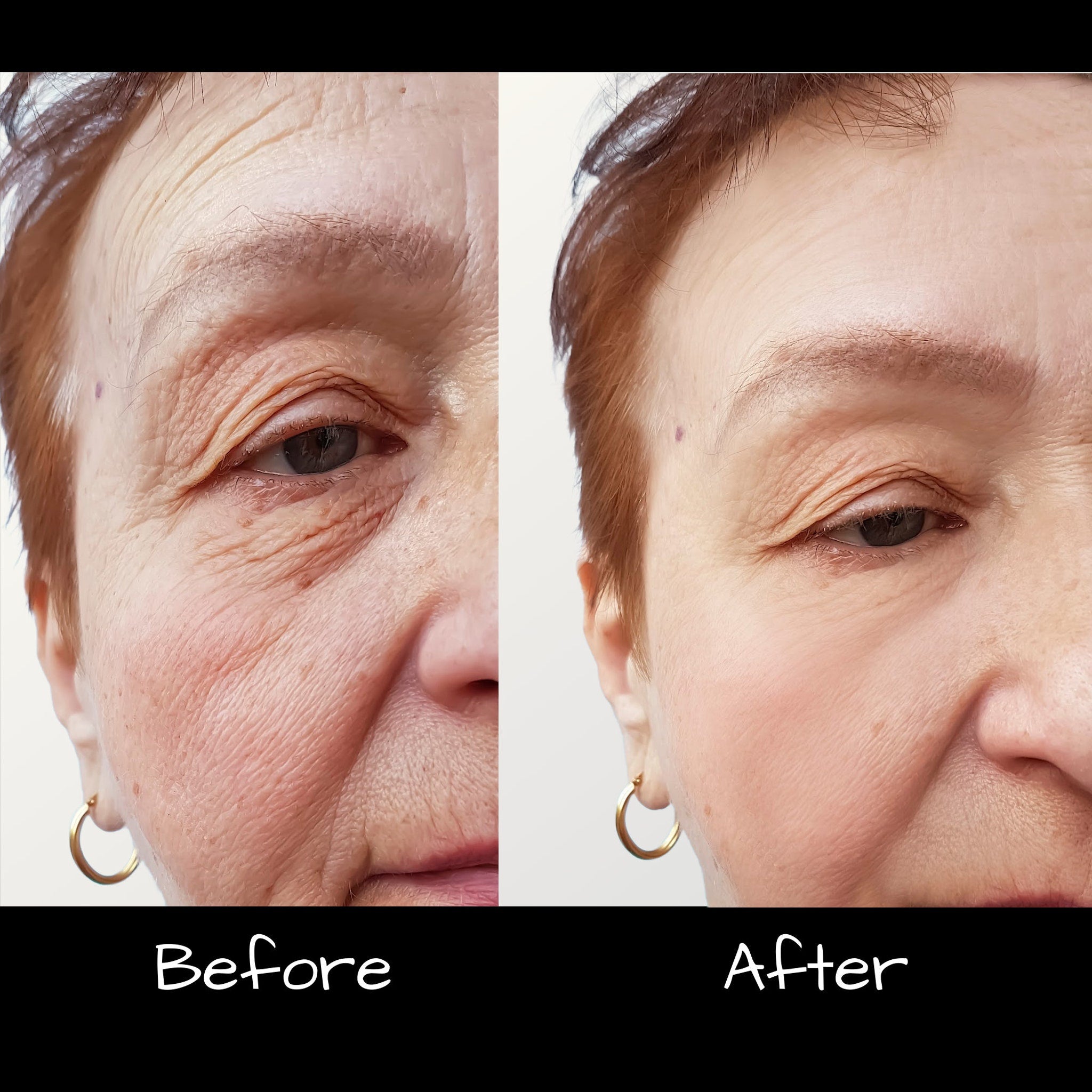 Wrinkle reduction comparison with before and after images of skin with visible lines and smooth skin
