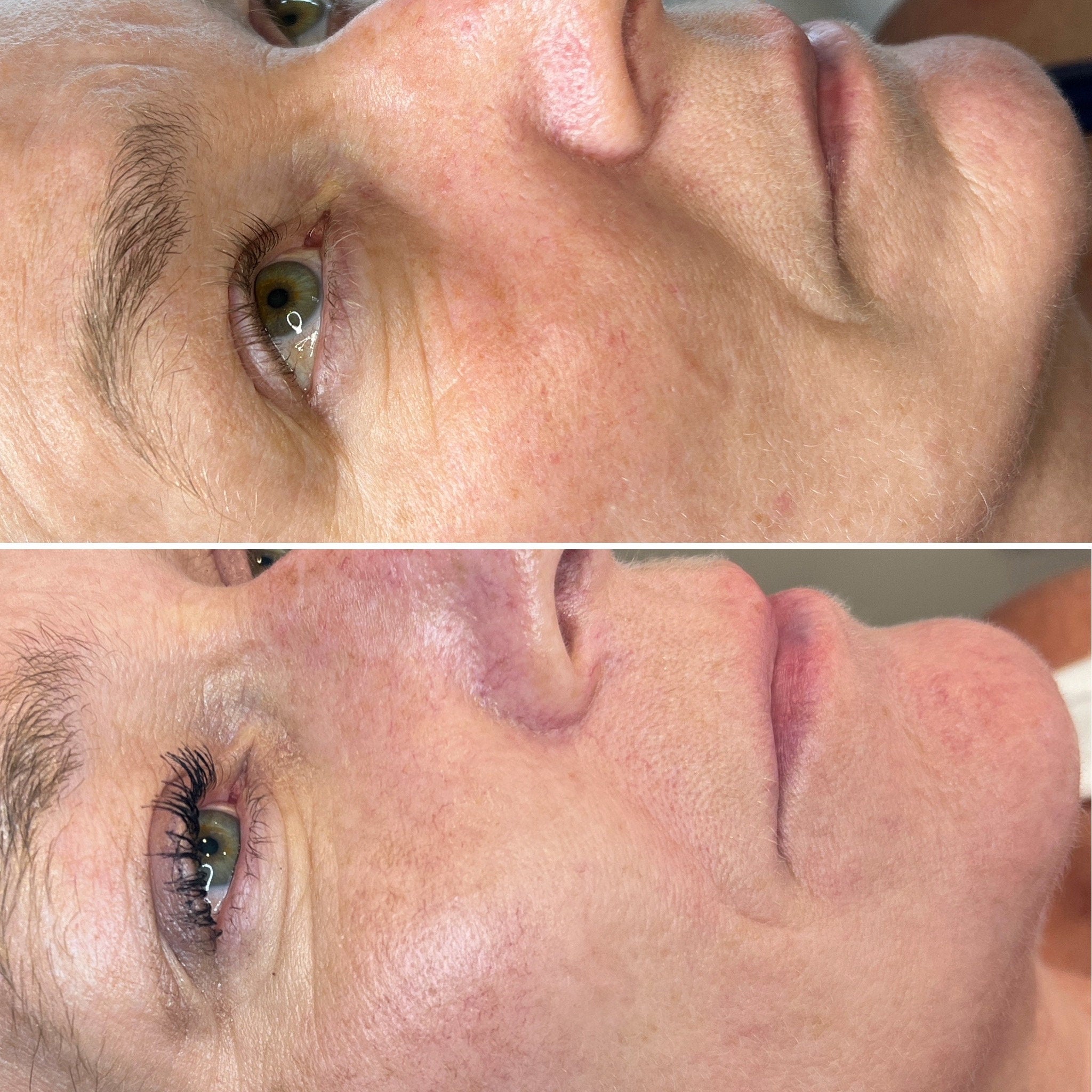 Skin treatment comparison showing skin texture, color, and eye detail before and after procedure