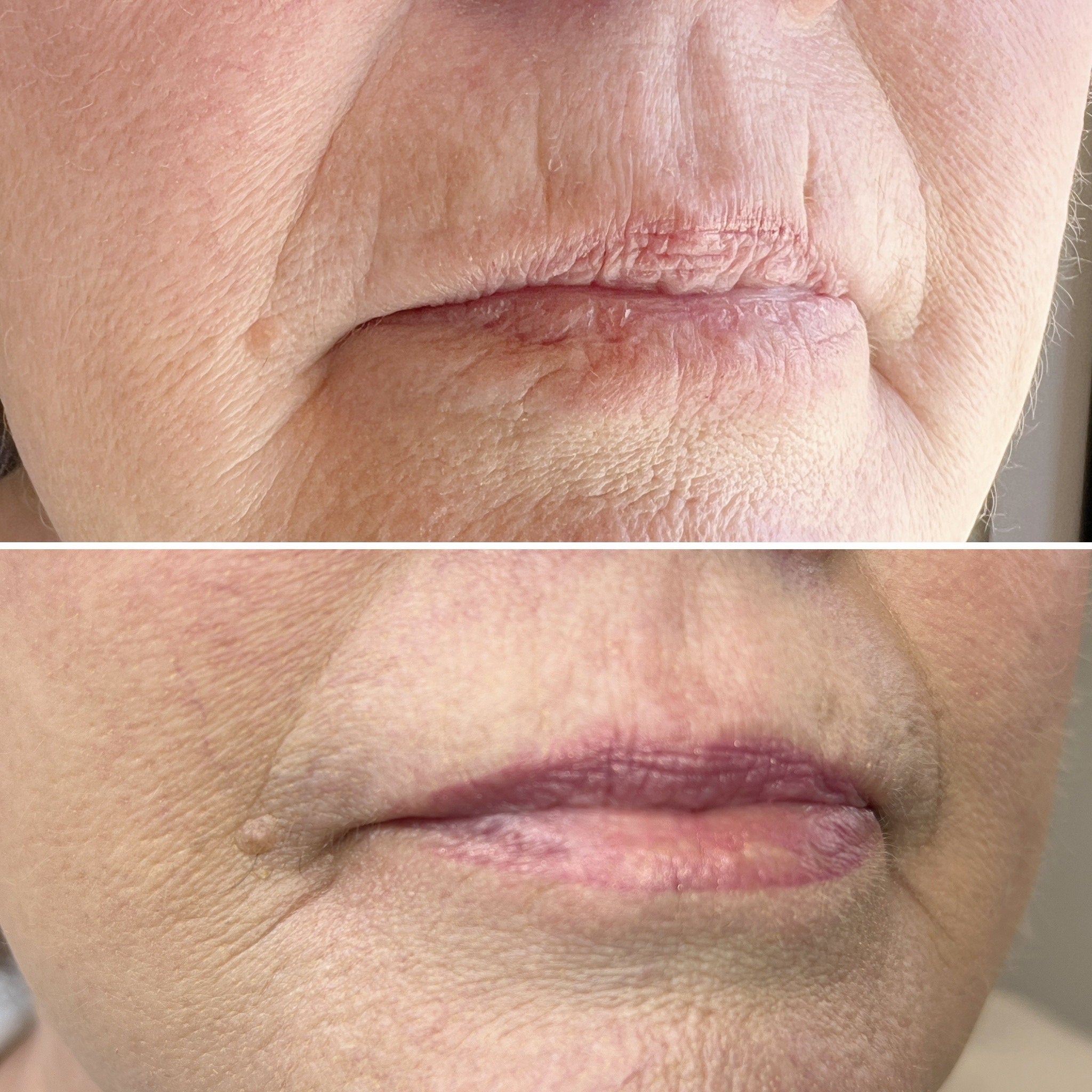 Wrinkled skin comparison, showing before and after, with dry, cracked lips and improved lip color
