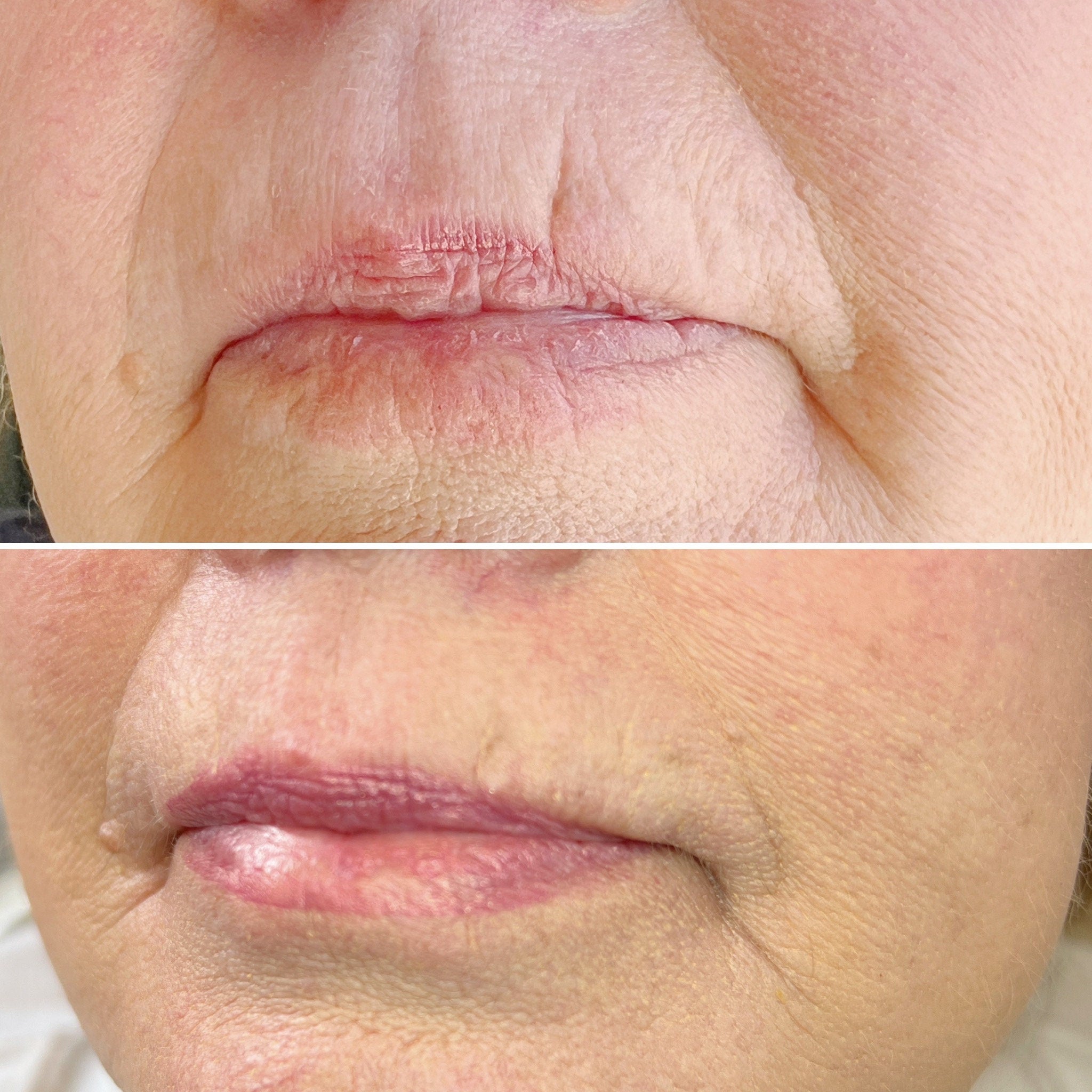 Lip skin before and after treatment, showing red, dry skin and smooth, pink lips with wrinkles