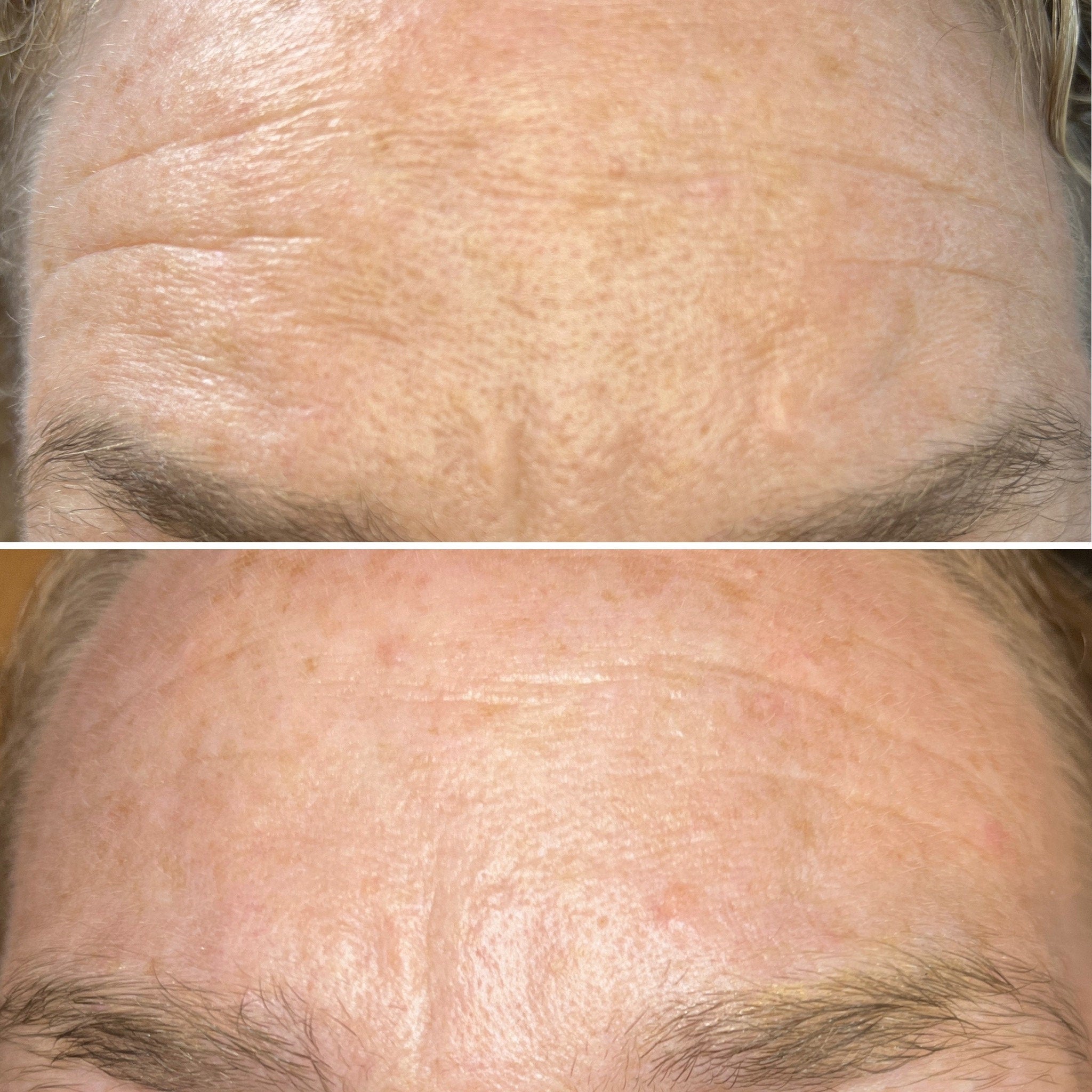 Forehead skin comparison, showing wrinkled and smooth areas, with visible fine lines and light skin tone