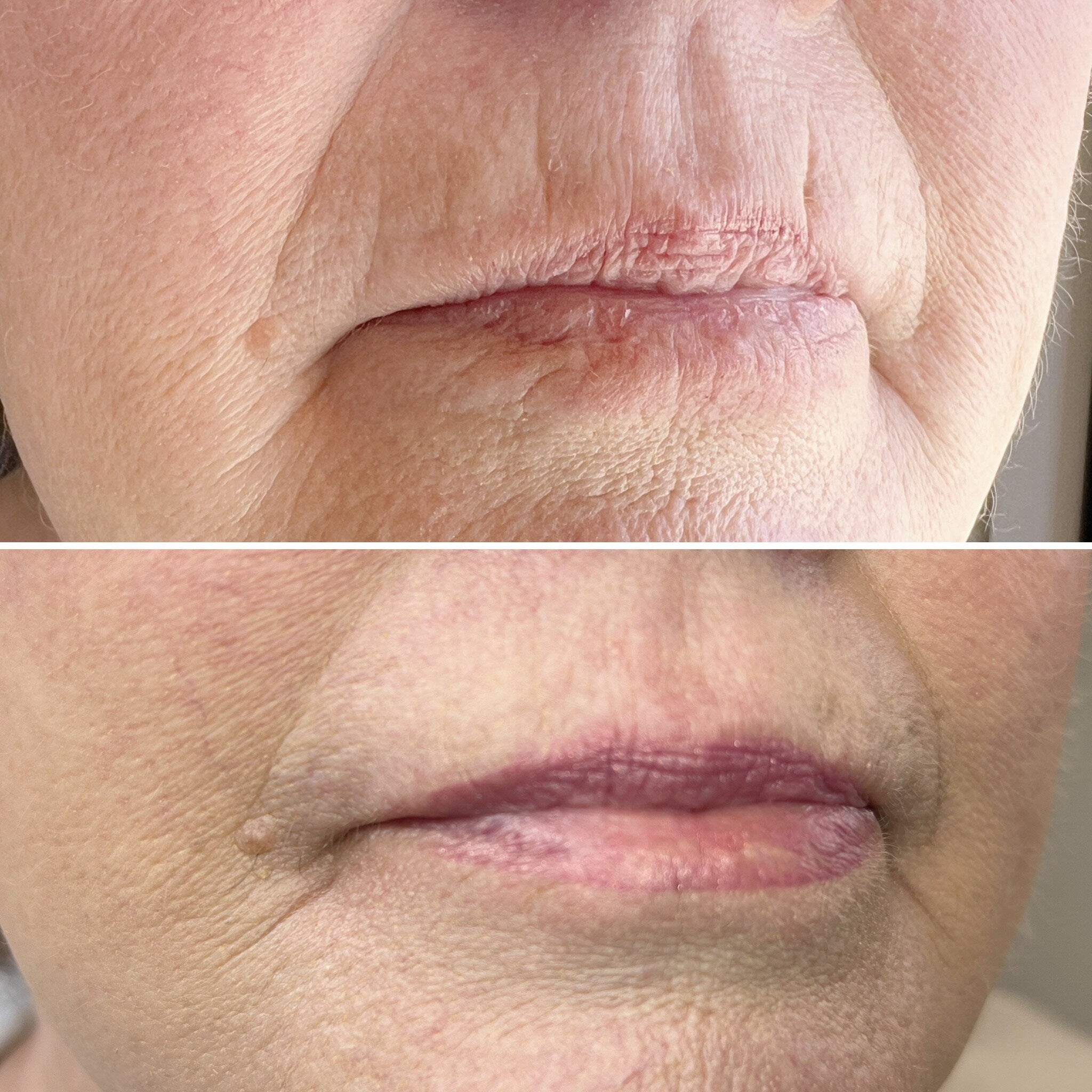Lip treatment before and after, showing pink lips, pale skin, and visible skin texture changes