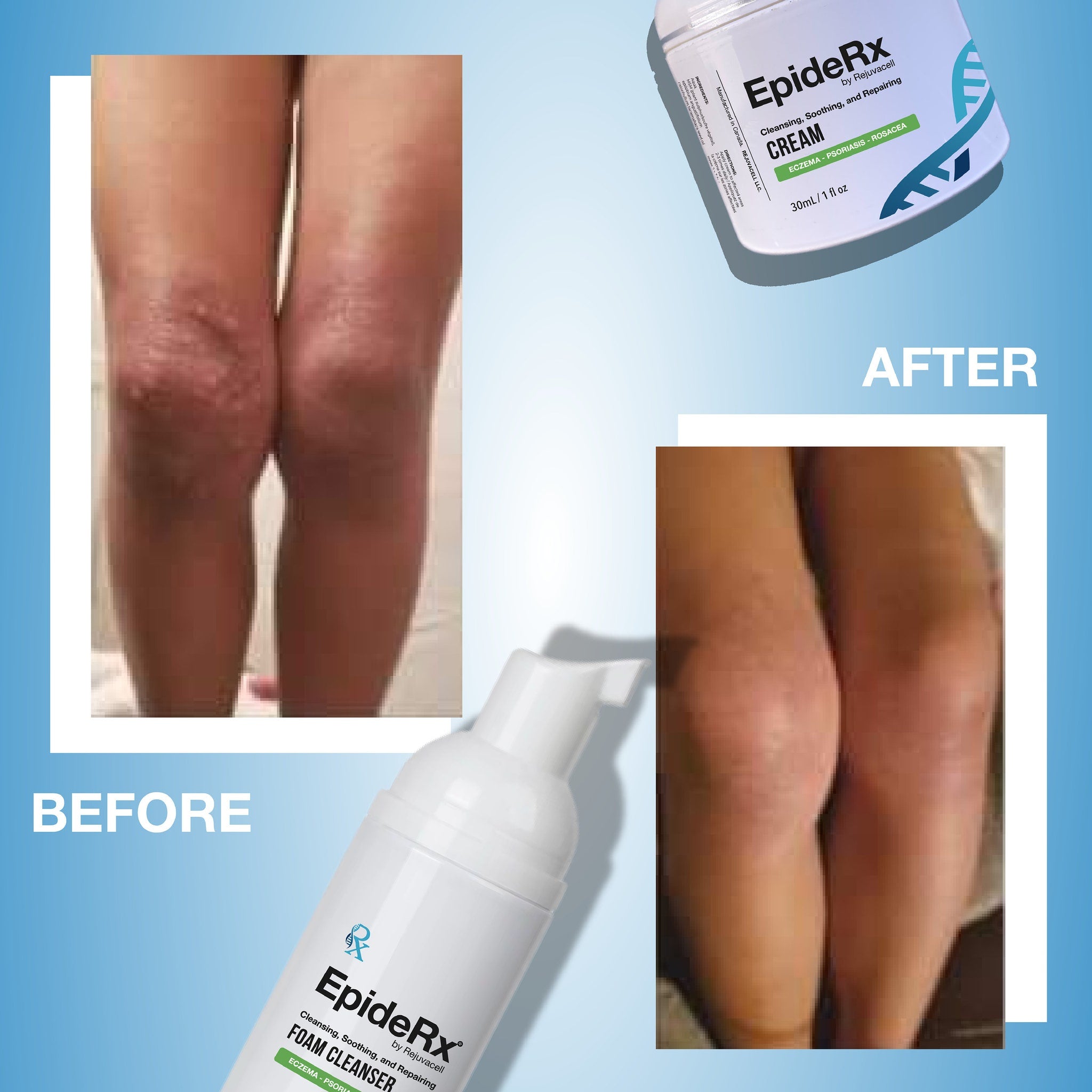 Eczema treatment before and after, showing red skin on legs, with EpideRx cream and cleanser bottles