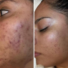 Acne treatment comparison, showing skin with red and purple blemishes, then clear skin with small spots.